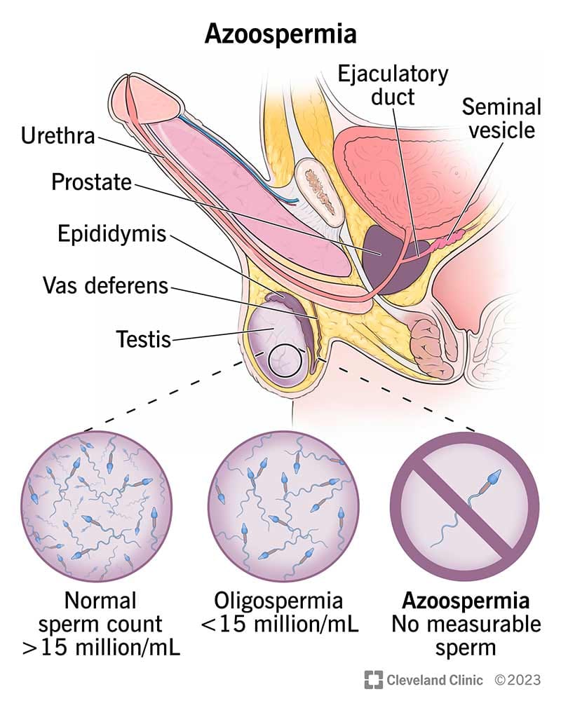 azoospermia