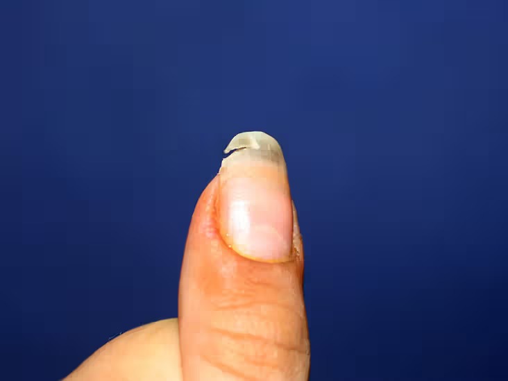 Chipped nail