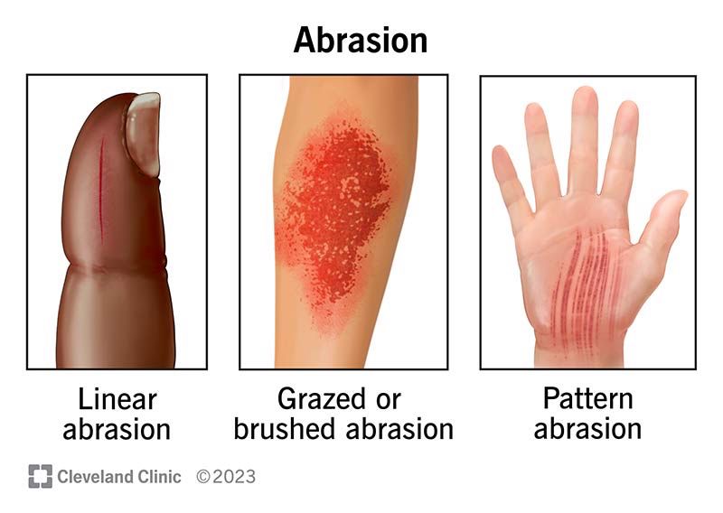 abrasion