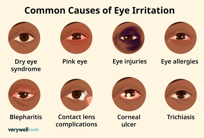 eye irritation