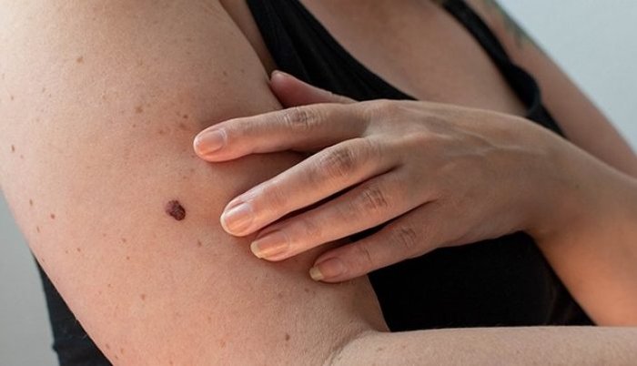mole