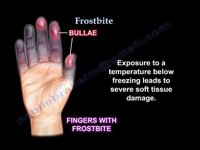 Frostbite
