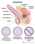 azoospermia