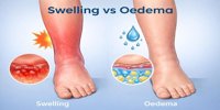 swelling