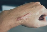 scar
